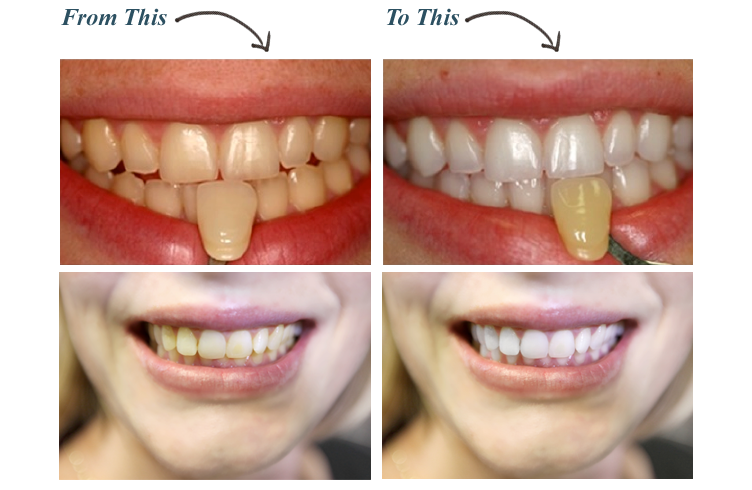 KoR Teeth Bleaching System