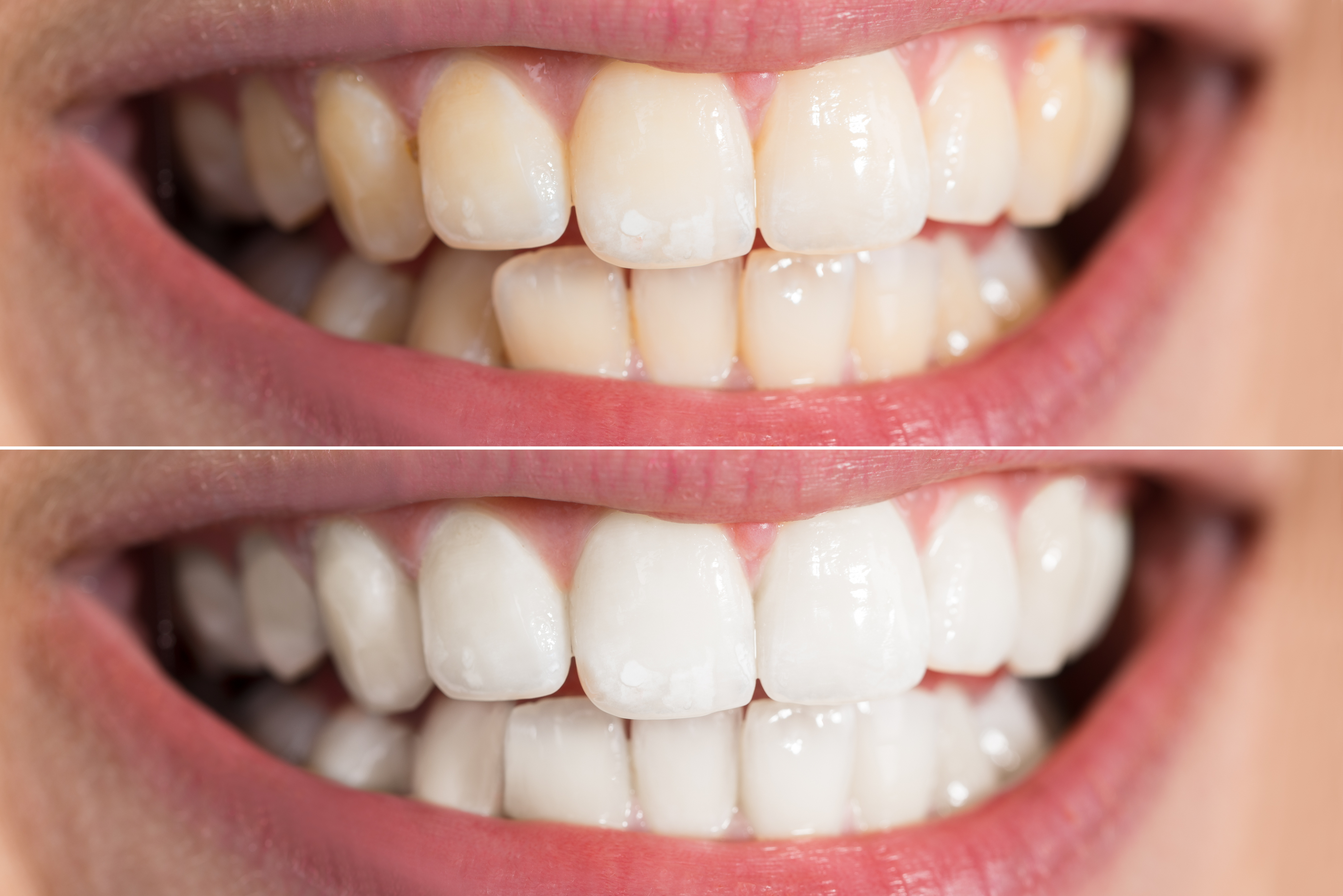 Image result for white spots on teeth after whitening