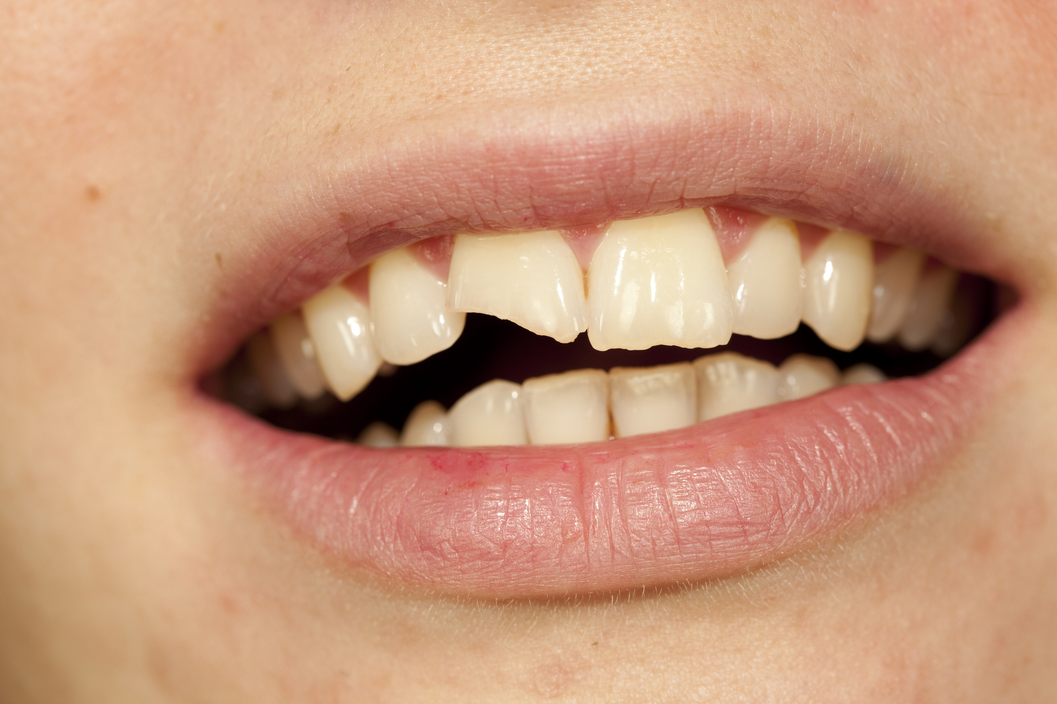 Person smiling with broken front teeth