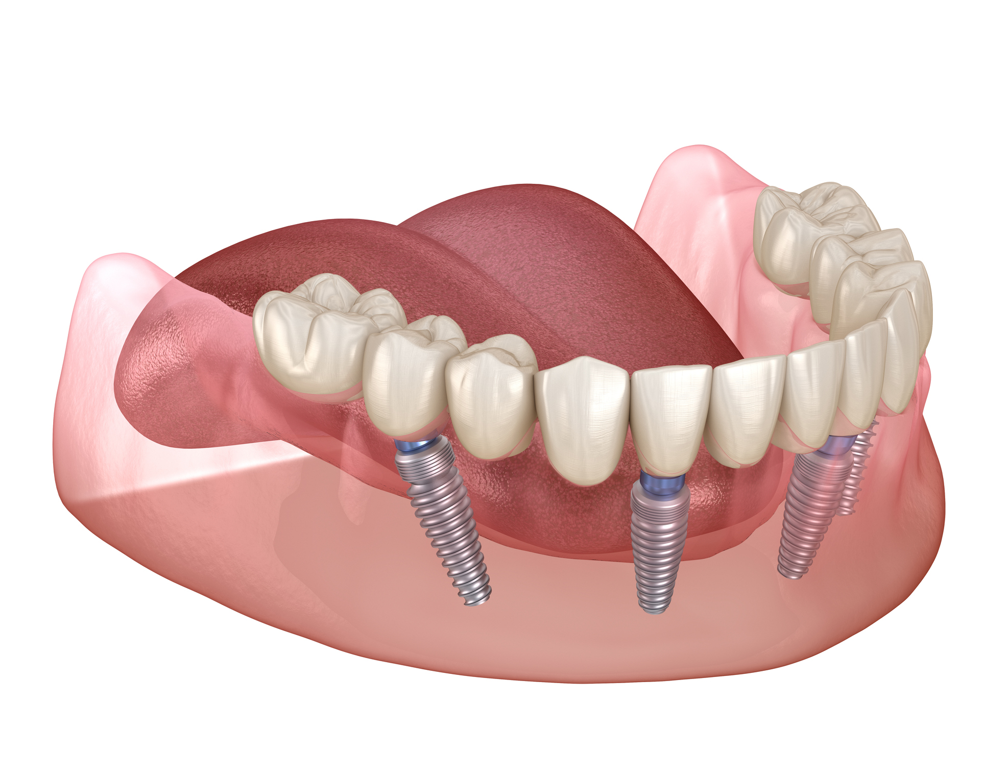 Graphic of lower teeth with dental implants.