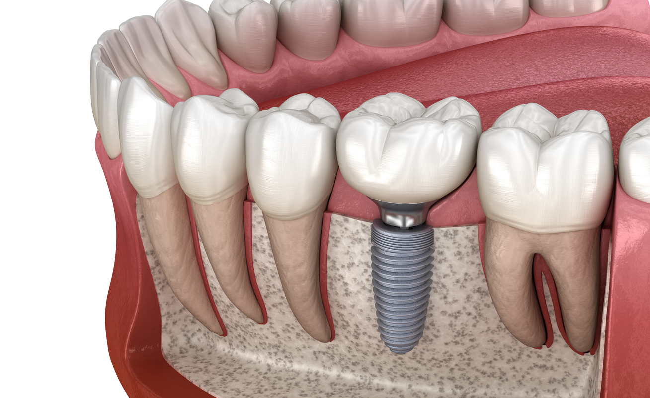 A 3D graphic of a dental implant in a a human jaw.